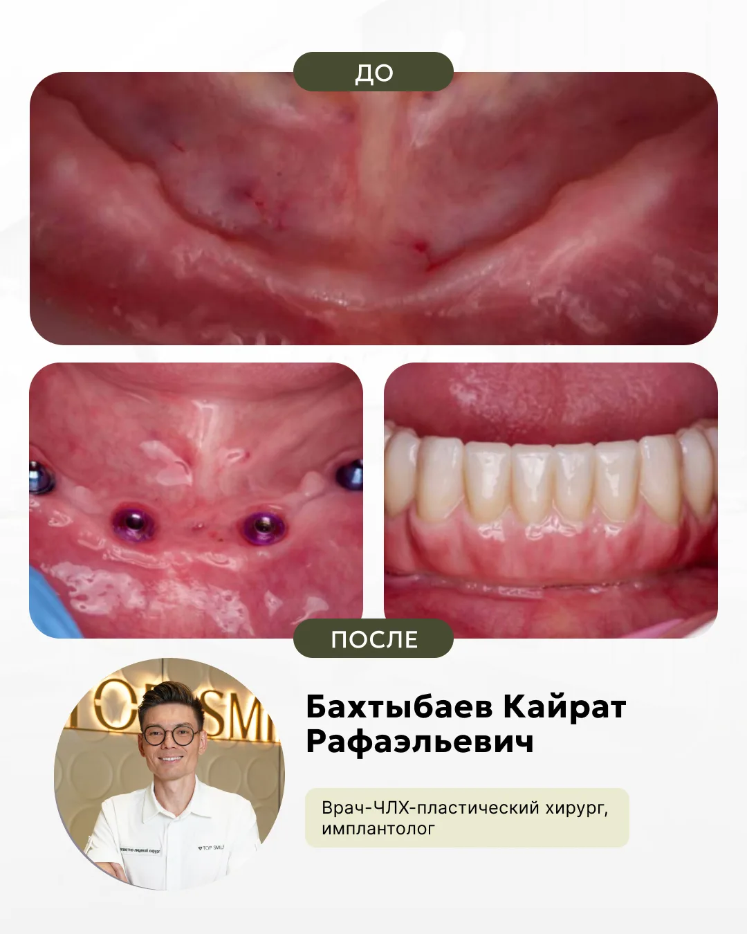 Синус-лифтинг, фото 3