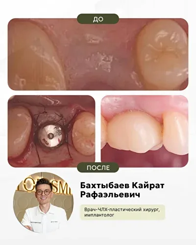 Работы нашего ведущего хирурга-имплантолога, фото 2
