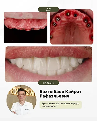 Работы нашего ведущего хирурга-имплантолога, фото 3