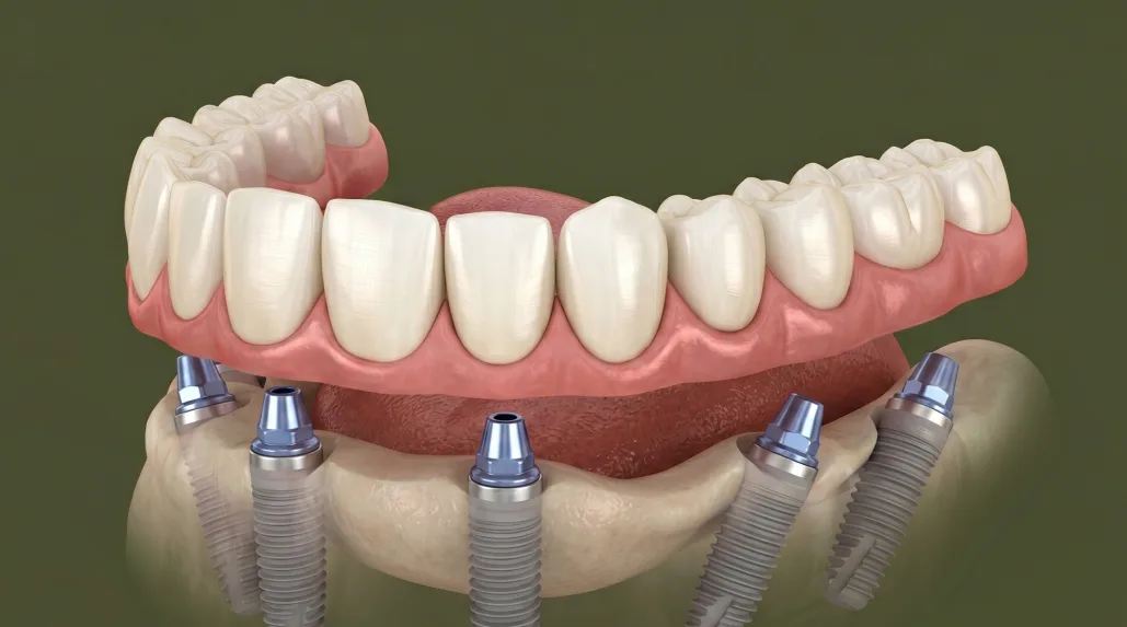 Имплантация all-on-6, фото 3