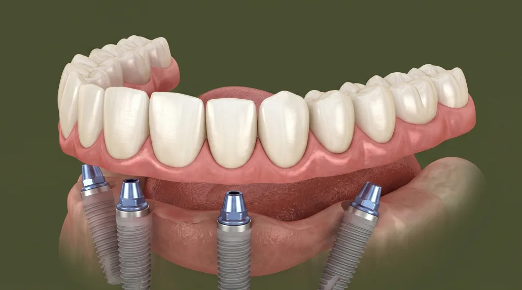 Имплантация all-on-4, фото 3
