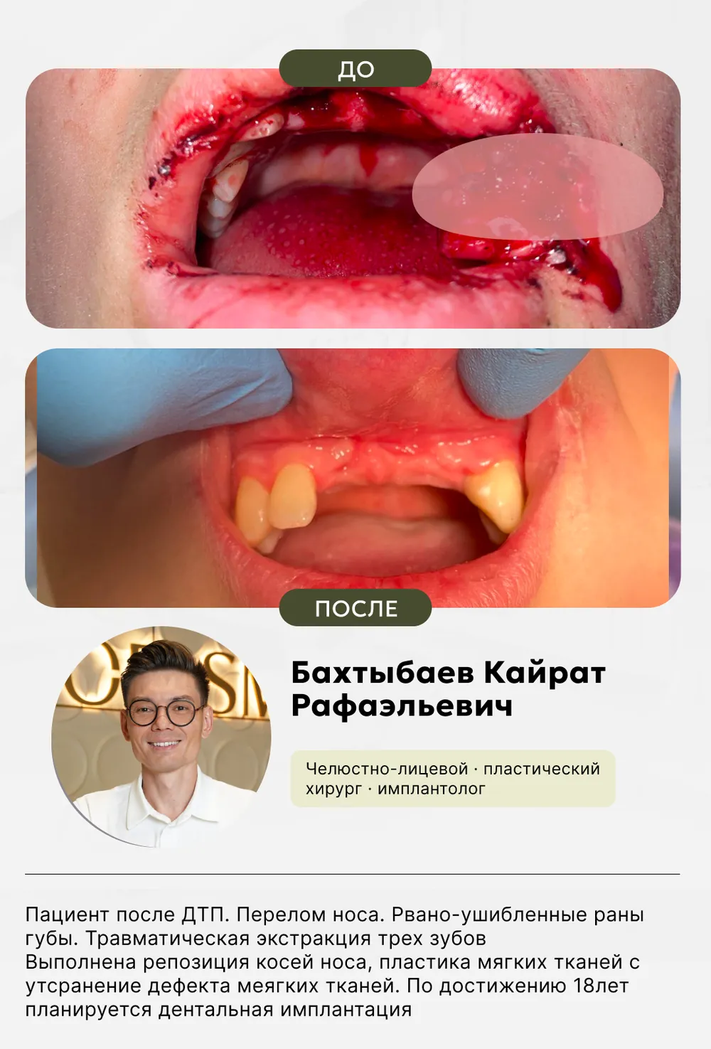 Челюстно-лицевая хирургия: до и после